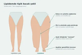Endolazer ile Lipödem Tedavisi