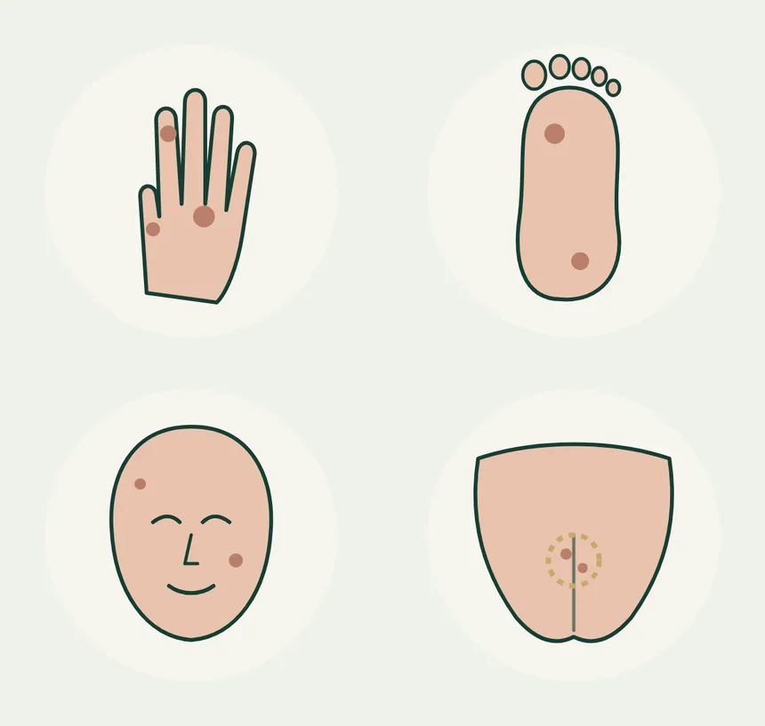 El, ayak tabanı, yüz ve anal-genital bölgede siğil yerleşimlerini gösteren temsili çizim