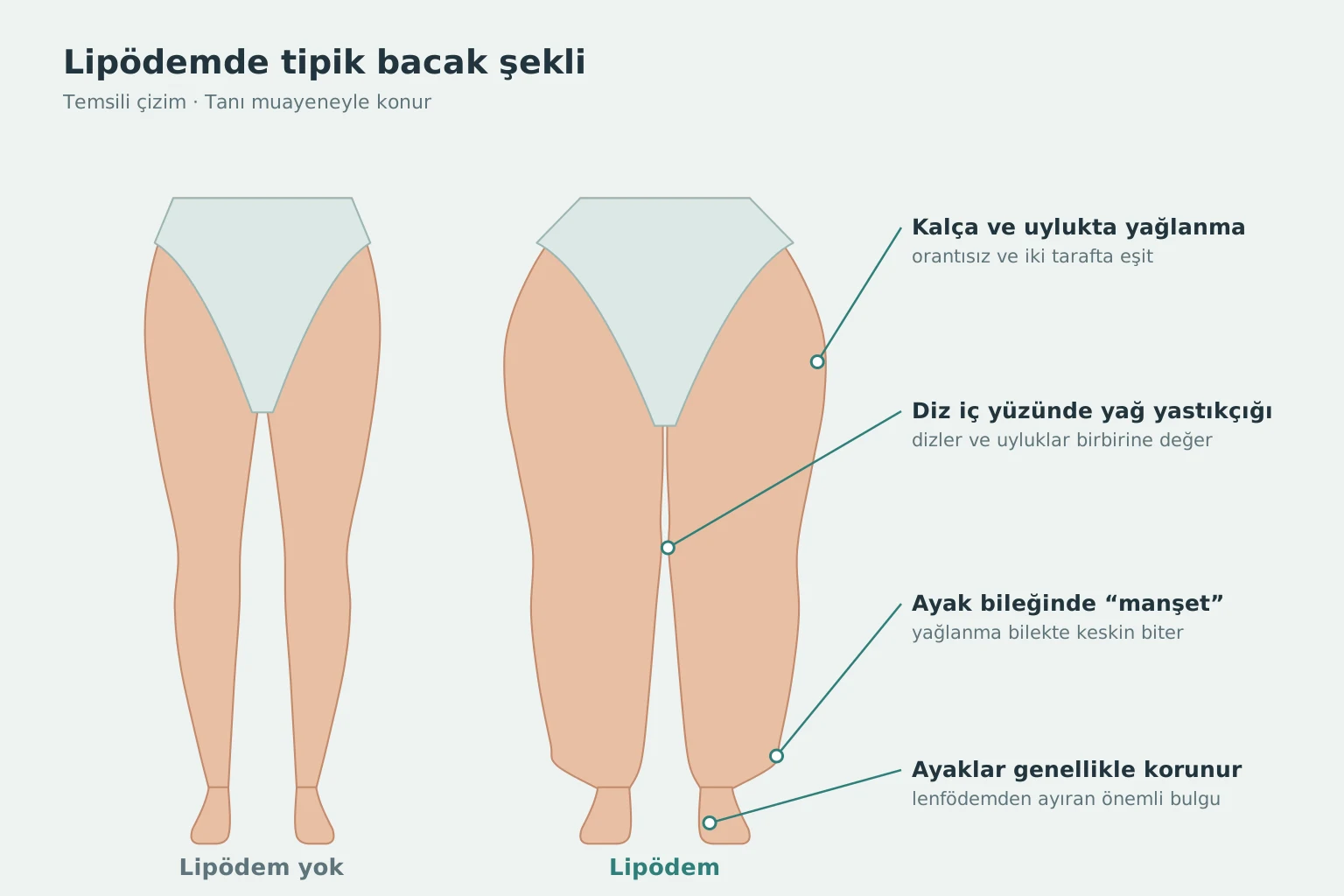 Lipödemde tipik bacak şekli