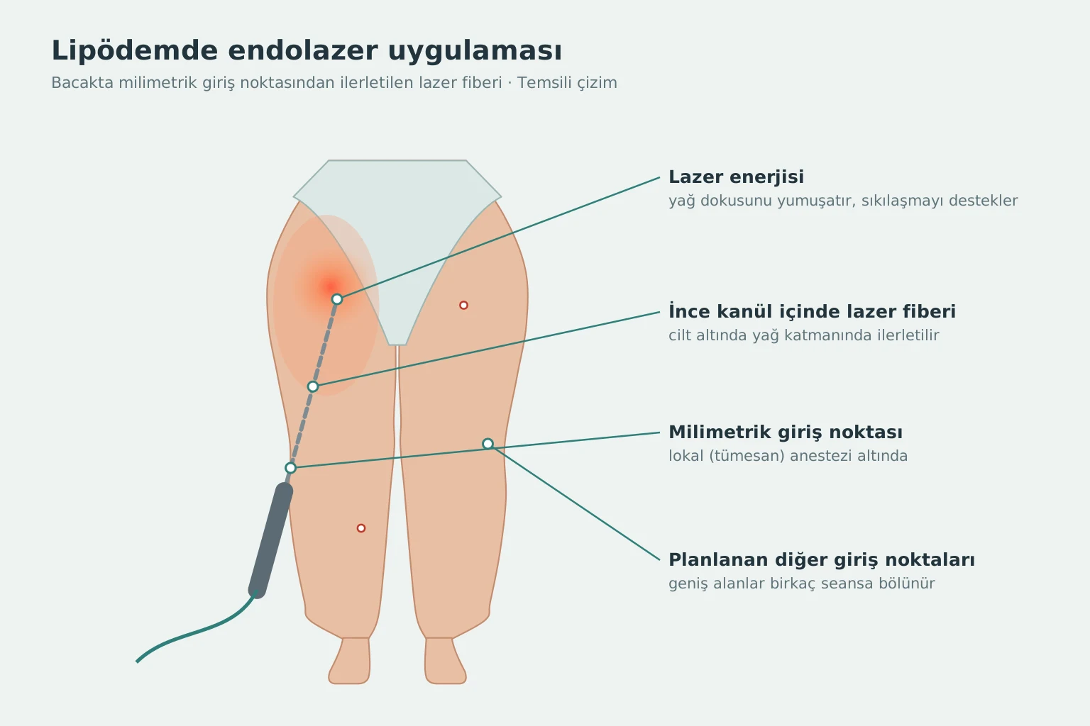 Lipödemde bacağa milimetrik giriş noktasından lazer fiberi ile endolazer uygulaması