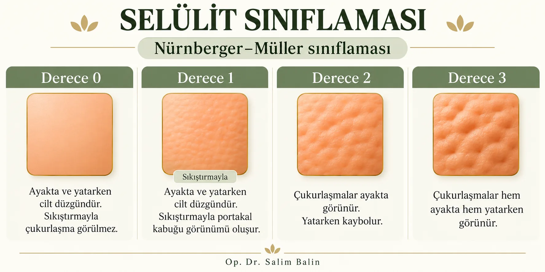 Selülit sınıflaması (Nürnberger–Müller): derece 0, 1, 2 ve 3 – temsili görsel