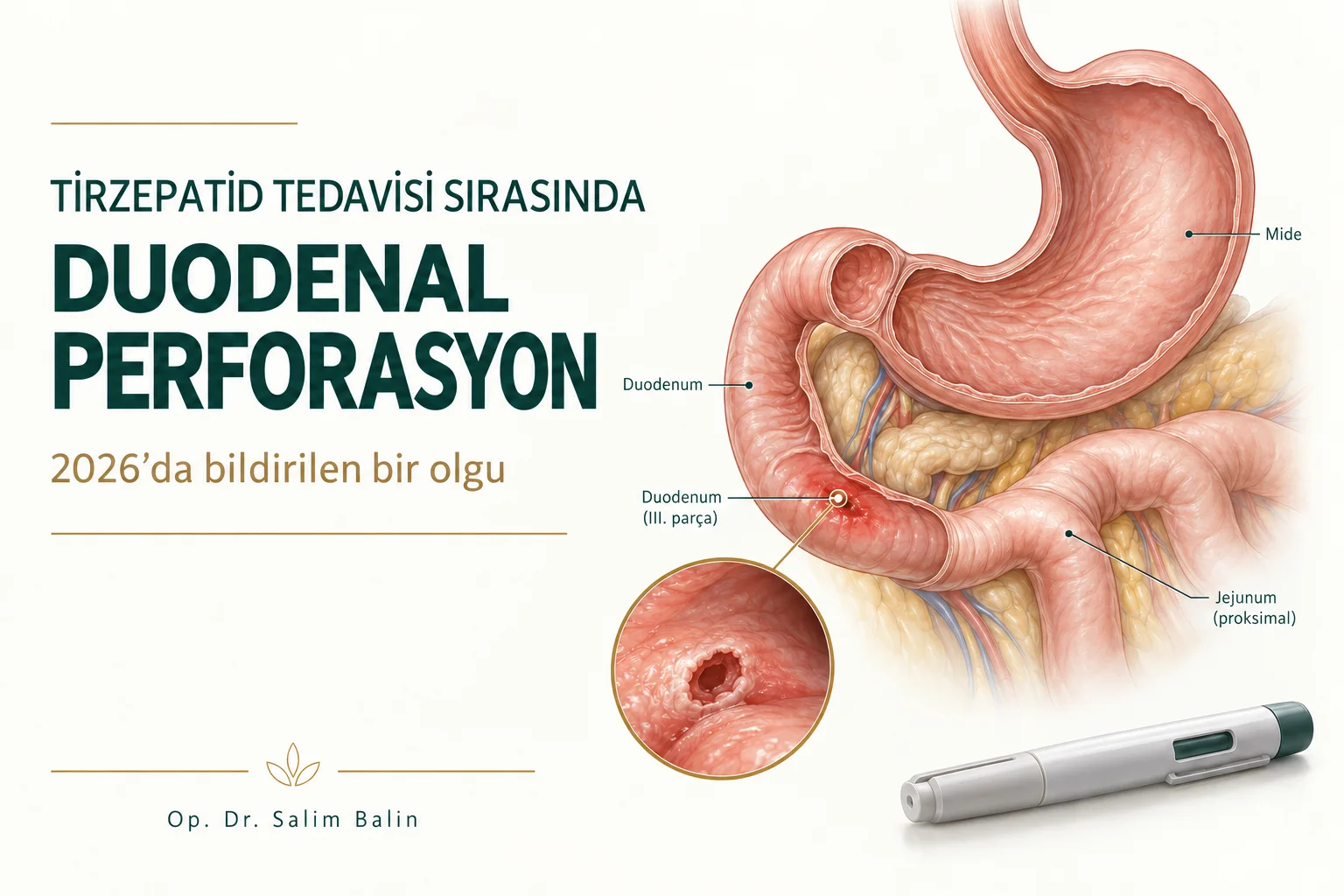 Tirzepatid tedavisi sırasında duodenal perforasyon: mide, duodenum (III. parça) ve jejunum çizimi ile enjeksiyon kalemi – 2026 olgusu, temsili görsel